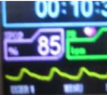 Fig. 7. Pantalla  del  monitor  mostrando  el  valor  mínimo (85%)  de saturación  de  la  hemoglobina  por  el oxígeno, zona de Cruz Blanca.
