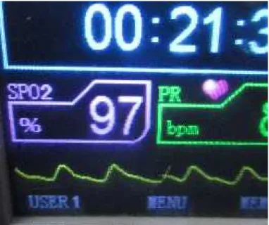 Fig. 9. Pantalla  del  monitor  mostrando  el  valor  máximo (97%)  de  saturación  de  la  hemoglobina  por  el oxígeno, zona de Cruz Blanca.