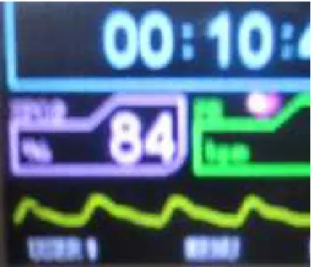 Fig. 11. Pantalla  del  monitor  mostrando  el  valor  mínimo (84%)  de saturación  de  la  hemoglobina  por  el oxígeno, zona de Huambocancha.