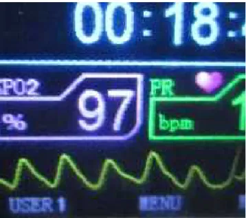 Fig. 13. Pantalla  del  monitor  mostrando  el  valor  mínimo (97%)  de  saturación  de  la  hemoglobina  por  el oxígeno, zona de Huambocancha.