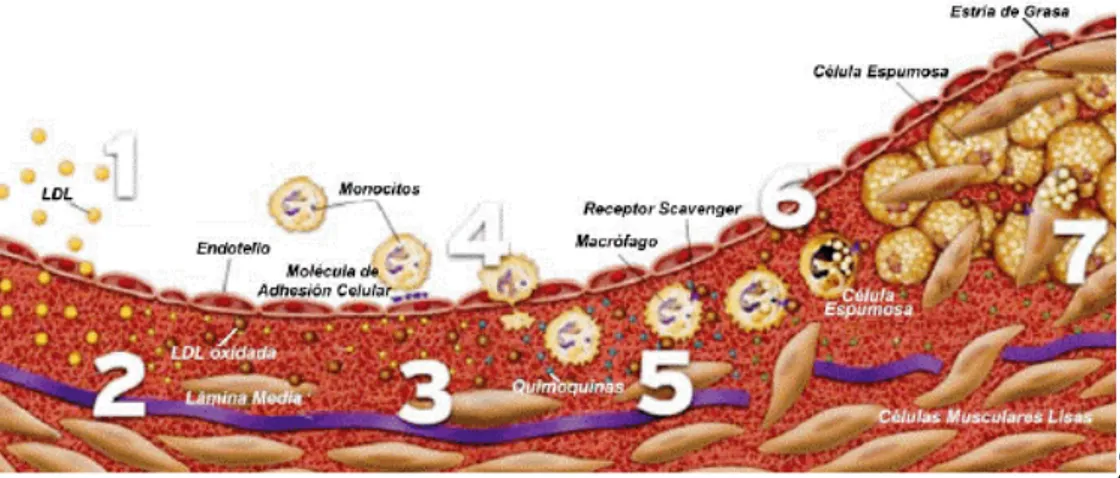Figura 8: Etapas en el desarrollo de la placa aterosclerótica. 1 y 2 Disfunción del endotelio y paso  de lipoproteínas LDL a la capa íntima del vaso