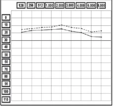 Figura 6: Tendencia promedio de la curva audiométrica en pacientes diabéticos tipo 2. 