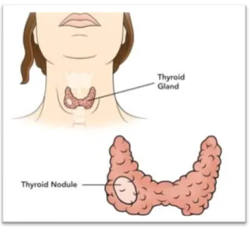 Gráfico 2. “Nódulo tiroideo” 