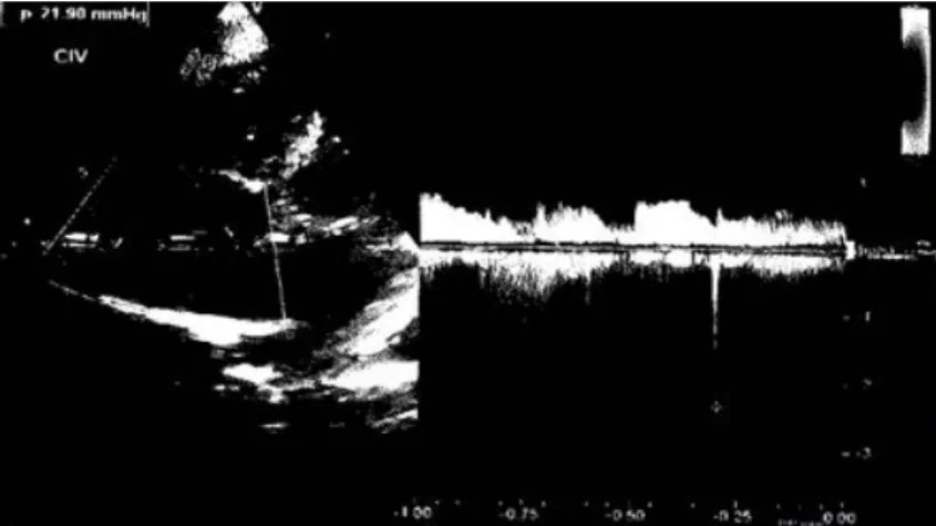 Figura 7: Existe comunicación interventricular  muscular de localización apical  aproximada-mente de 2mm.