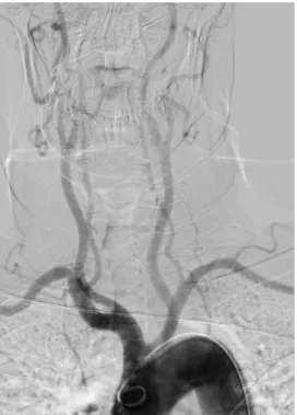 Figura  1.  Arteriografía  de  los  troncos  supraaórticos.  Arco  aórtico  y  origen  de  sus  ramas principales 