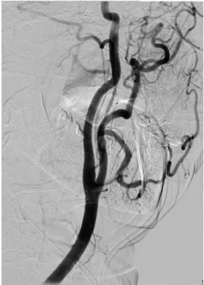Figura  2. Arteriografía cerebral. Arteria carótida común (ACC) y bifurcación carotídea  en arteria carótida interna (ACI, izquierda) y externa (ACE, derecha) 