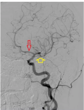 Figura  4. Circulación anterior. Arteriografía cerebral que muestra los 7 segmentos de  la arteria carótida interna y su bifurcación intracraneal en arteria cerebral media (ACM,  flecha amarilla) y arteria cerebral anterior (ACA, flecha roja) 