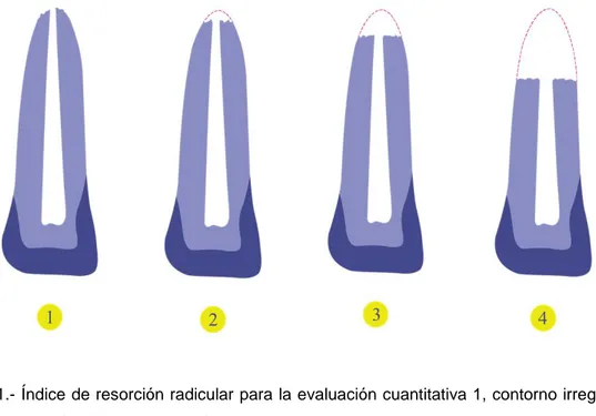 Figura 1.- Índice de resorción radicular para la evaluación cuantitativa 1, contorno irregular de  la  raíz