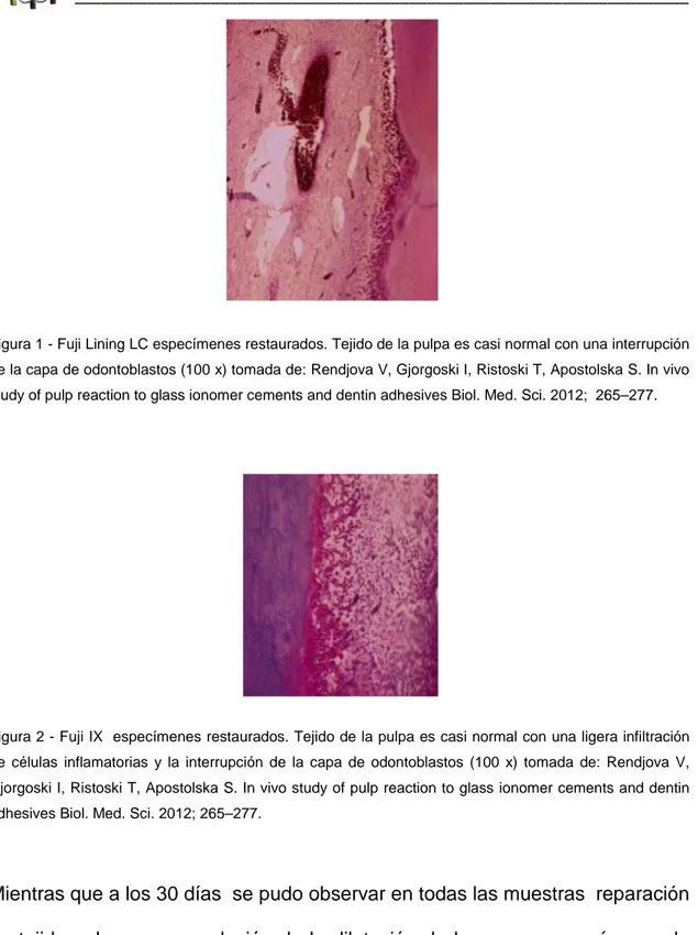 Figura 1 - Fuji Lining LC especímenes restaurados. Tejido de la pulpa es casi normal con una interrupción  de la capa de odontoblastos (100 x) tomada de: Rendjova V, Gjorgoski I, Ristoski T, Apostolska S