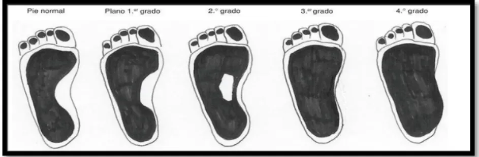 Gráfico 7 Grados de pie plano 
