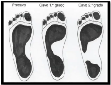 Gráfico 8 Grados de Pie Cavo  
