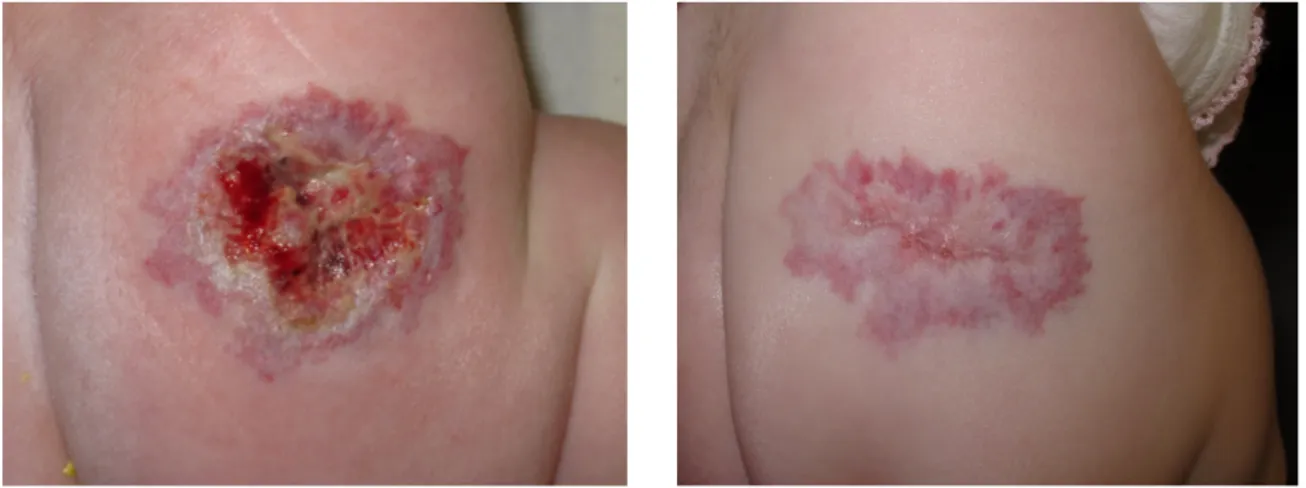 Figura	
  9	
  -­‐	
  HI	
  en	
  glúteo	
  ulcerado	
  antes	
  y	
  después	
  de	
  tratamiento	
  con	
  láser 	
   	
  	
  	
  