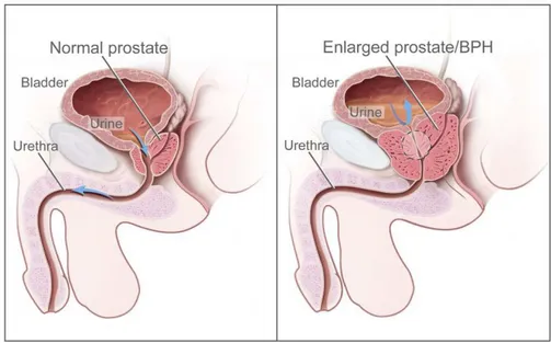 Figure 2.5. Benign prostatic hyperplasia. This pathology provokes the enlargement of the prostate, which presses on the bladder and the urethra hence obstructing the flow of urine