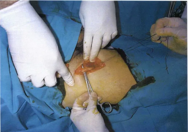 Foto 2. Disección de arteria y vena femoral.