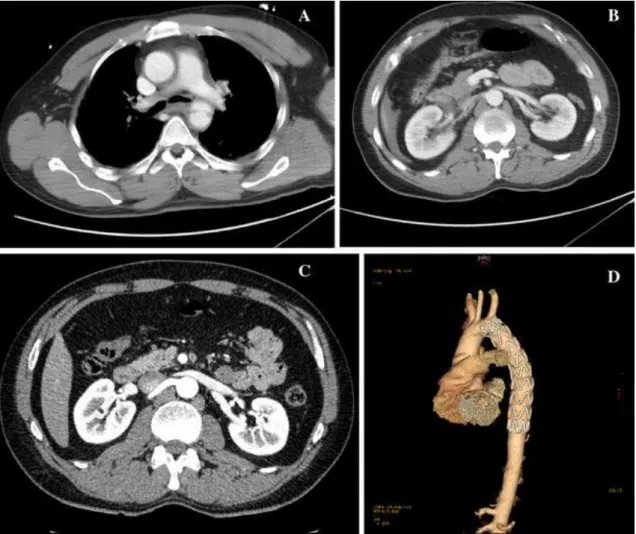 Fig. 2.  On  admission  and  1 week  later,  control  MDCTs  were  taken  of  patient  no