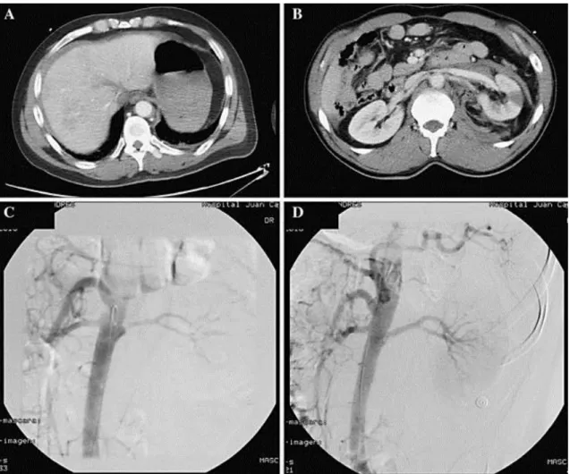 Fig. 3. On admission, MDCT and aortography images were taken of patient no. 8 of group A