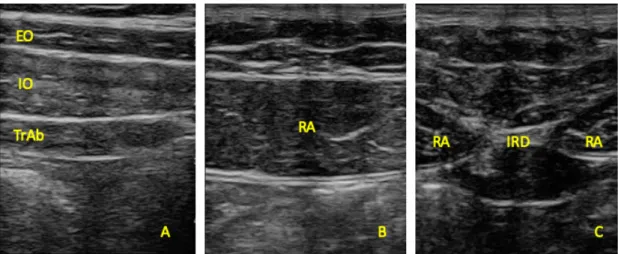 Figure 1. Ultrasound imaging thickness for the EO, IO, TrAb (A), RA thickness (B) muscles, and IRD  (C)