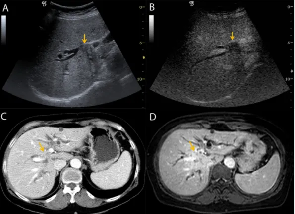 Figura  1. Tumor  de  Klatskin.  La  ecografía  basal  (A)  muestra  una  lesión  intraductal  en  el  hilio  hepático