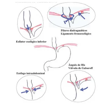 Figura 2 Esquema de la barrera antirreflujo gastroesofágico 