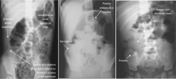 Figura  4.  Imágenes  radiográficas  abdominales  en  pacientes  con  diagnostico de apendicitis aguda