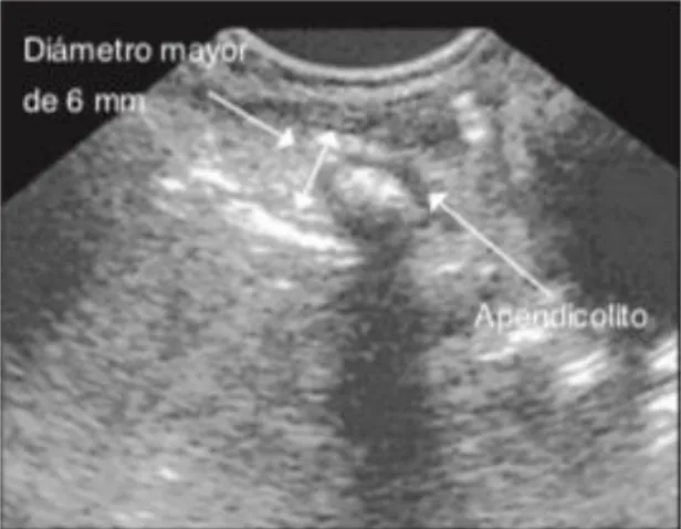 Figura 5. Imágenes ultrasonograficas en pacientes con apendicitis aguda. ´ 