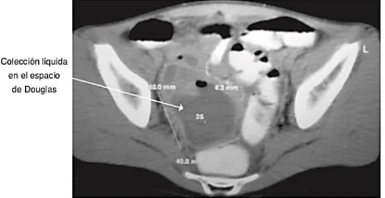 Figura 6 imágenes tomograficas en pacientes con apendicitis aguda. 