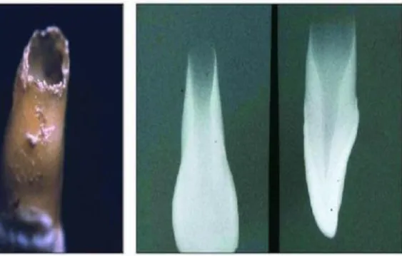 Gráfico  1: Dientes inmaduros 