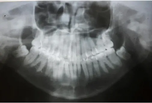 FOTO 2: Radiografía Panorámica 