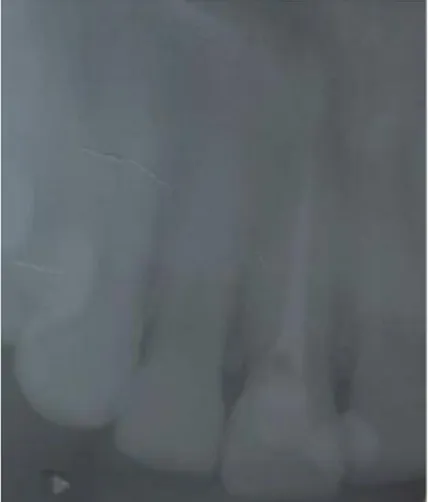 FOTO 4: Radiografias Periapicales distal a mesial. 