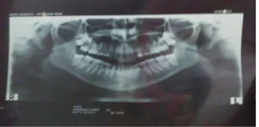 Foto 11. Radiografía preoperatoria donde se observa los terceros molares  superiores y inferiores en posición vertical, clase I, nivel A