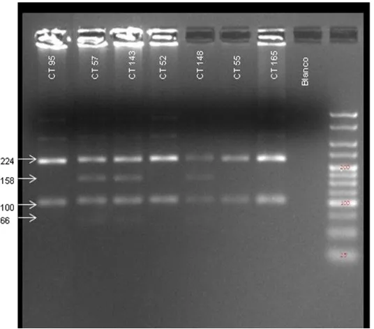Figura 5: RFLPs obtenidos con la enzima Pst1 de los productos amplificados por PCR que contienen el polimorfismo Lys751Gln de XPD en alguno de los casos