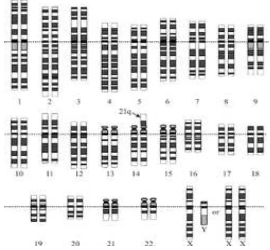 Figura 2. Cariotipo que corresponde a una trisomía con traslocacion robertsoniana. Se observan dos cromosomas 21 y un cromosoma extra 21 fusionado al cromosoma 14 (22)