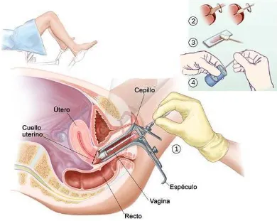 Figura 4.  Toma de muestra para Papanicolaou  