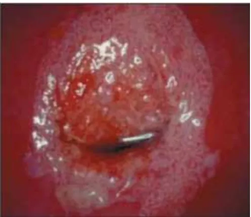 Figura 13. Cervicitis crónica: este cuello uterino presenta una inflamación importante, aspecto rojizo y sangra al tacto, zonas acetoblancas poco definidas, irregulares, salpicadas en el cuello uterino (tras aplicar ácido acético) 