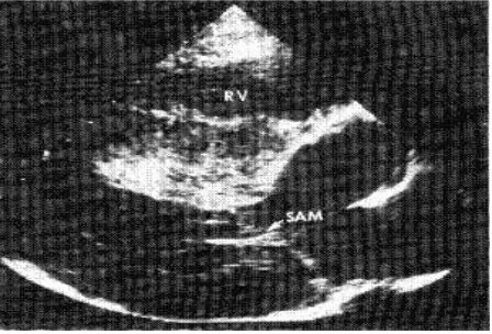 Fig. 5. Ecocardiografía 2D vista paraesternal eje largo donde se observa hipertrofia septal marcada con obstrucción al TSVI y SAM