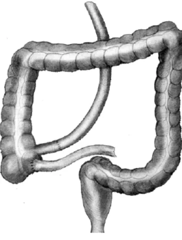 Figura 1. Primer modelo de cirugía disortiva bypass yeyuno-ileal. Dr. Varco 1953. 