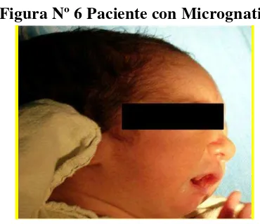 Figura Nº 6 Paciente con Micrognatia 