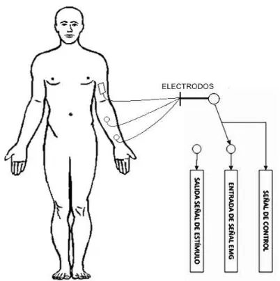 Figura 10. Colocación de los electrodos en mimbro superior. Modo recompensa. 