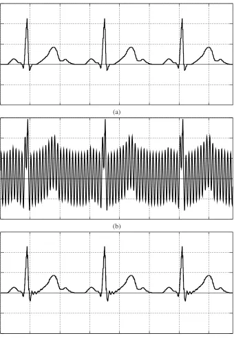 Figure 5: Removing mains-frequency interference from an electrocardiogram.