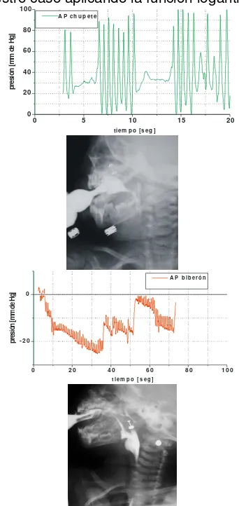Figura 2. Curvas típicas de presión para succión no productiva (chupete) y productiva (biberón), y sus imágenes radiológicas