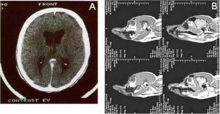 Fig. 7. Neuroimágenes  funcionales. A. PET Tomografía por Emisión de Positrones (corte oblicuo a nivel de los ganglios de la base en un hombre)