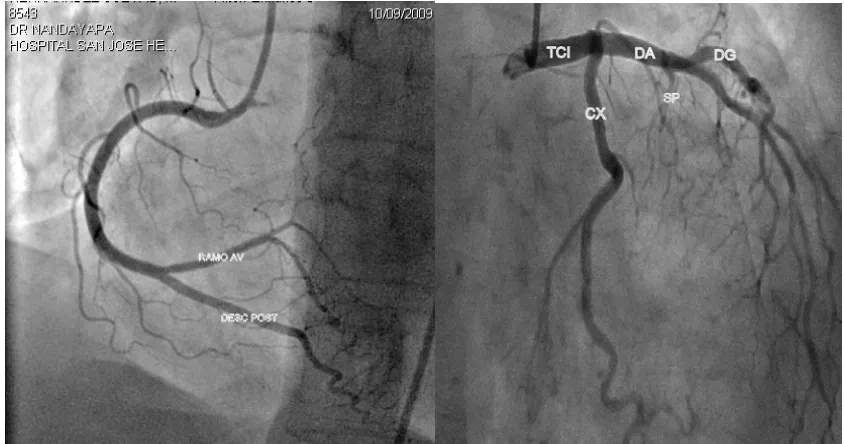 figura). La CD rodea en la imagen lo que corresponde al anillo tricuspídeo (a 