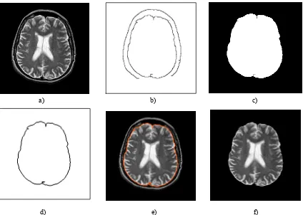Fig. 2 Segmentación del cráneo y las meninges en una imagen coronal de RM Tdistancia geodésica d) borde exterior del cerebro e) imagen original superpuesto el borde exterior del cerebro f) imagendespués de aplicarle los filtros secuenciales, extraídos los 