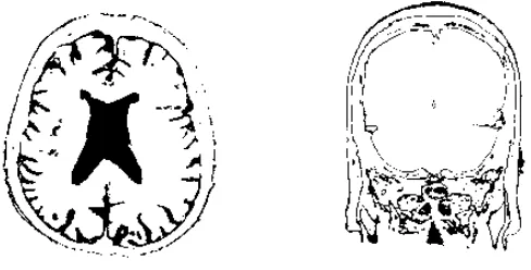 Fig. 3 Imágenes axial y coronal umbraladas con elección de umbral óptimo.
