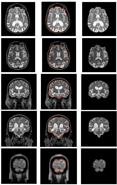 Fig. 6 Segmentación del cráneo y las meninges en imágenes de RM Timágenes originales. En la segunda columna se presentan superpuestas a las imágenes originales los bordes externos de2