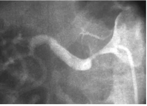 Figure 2Anteroposterior digital subtraction arteriography shows a severe right renal artery stenosis
