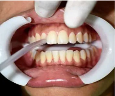 Figura  #7  Aplicamos  aire  a  presión  constante  en  los  dientes  para  secarlos  y  prepararlos para aplicar el desensibilizante