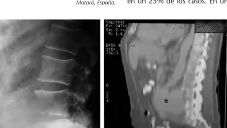 Figura 1. A) Proyección radiológica lateral, donde se aprecia la lisis de los cuerpos vertebrales debido al aneurisma