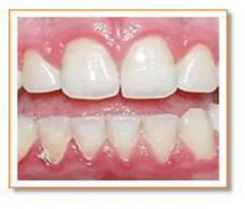 Fig. 2 Gingivitis, www.dentalhealthonline.com
