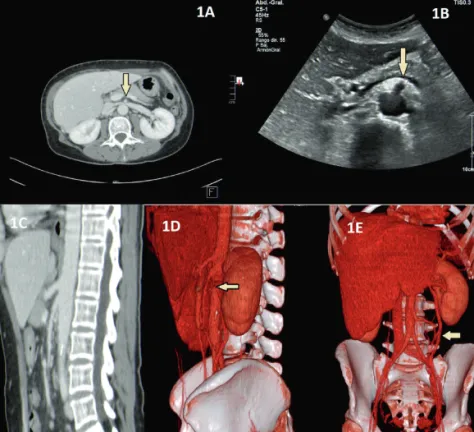 Figura 1. A-D Vena renal izquierda parcialmente colapsada por disminución del ángu- ángu-lo  entre  arteria  mesentérica  superior  y  aorta